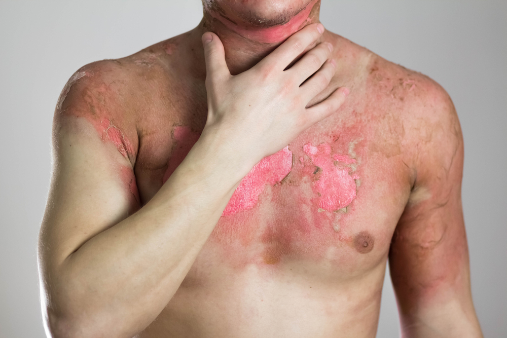 Man with a severe burn all over his body