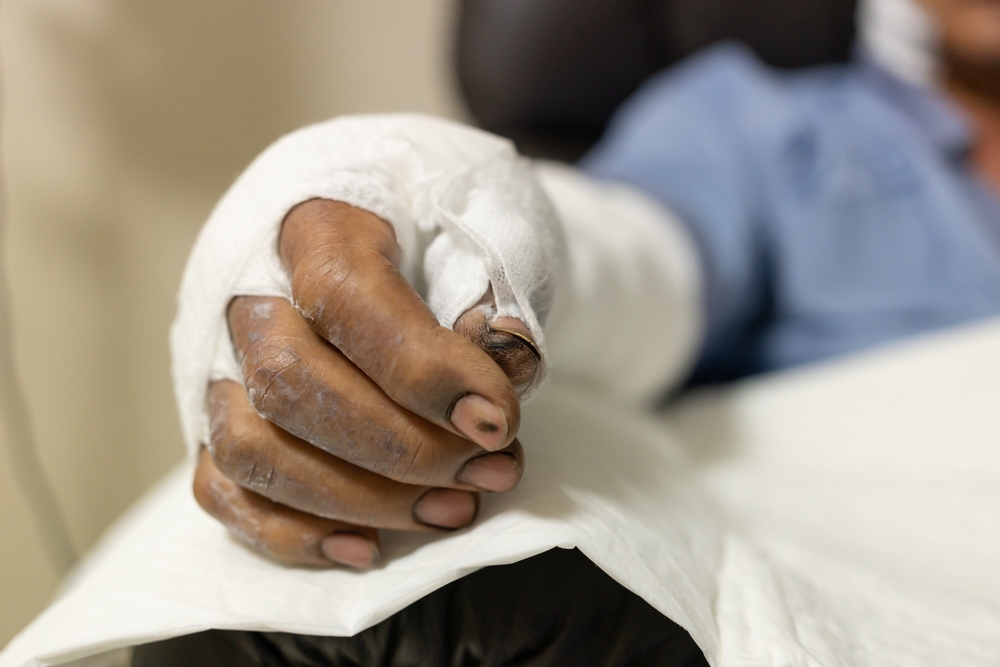 Patient with burns in the hospital. applying bandage onto patient's arm burn wound.